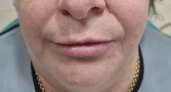 Antes do tratamento: Aplicação de Ácido Hialurônico no Sulco Nasolabial