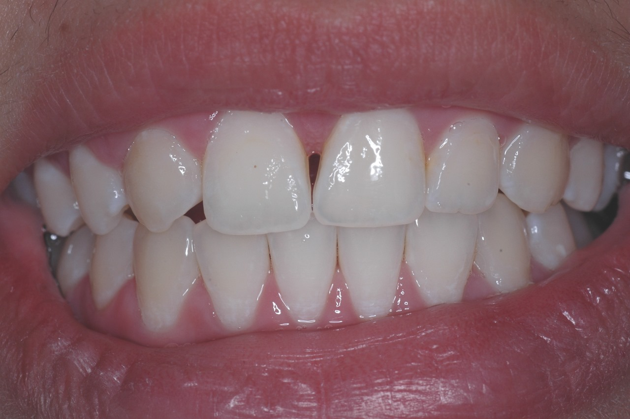 Antes do tratamento: Fechamento de Diastema