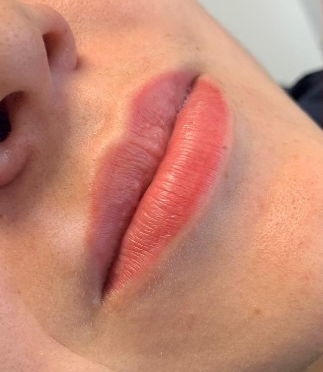 Antes do tratamento: Harmonização Facial