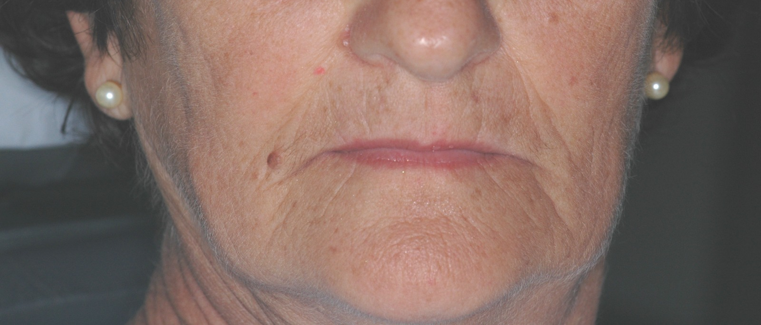 Depois do tratamento: Levantamento de Dimensão Vertical