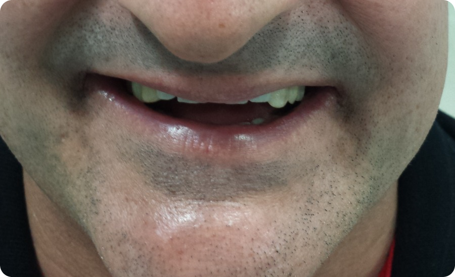 Antes do tratamento: Prótese Sobre Implante