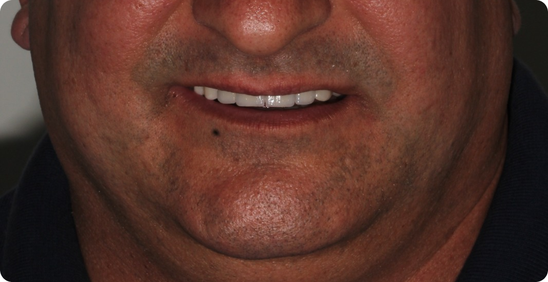 Depois do tratamento: Prótese Sobre Implante