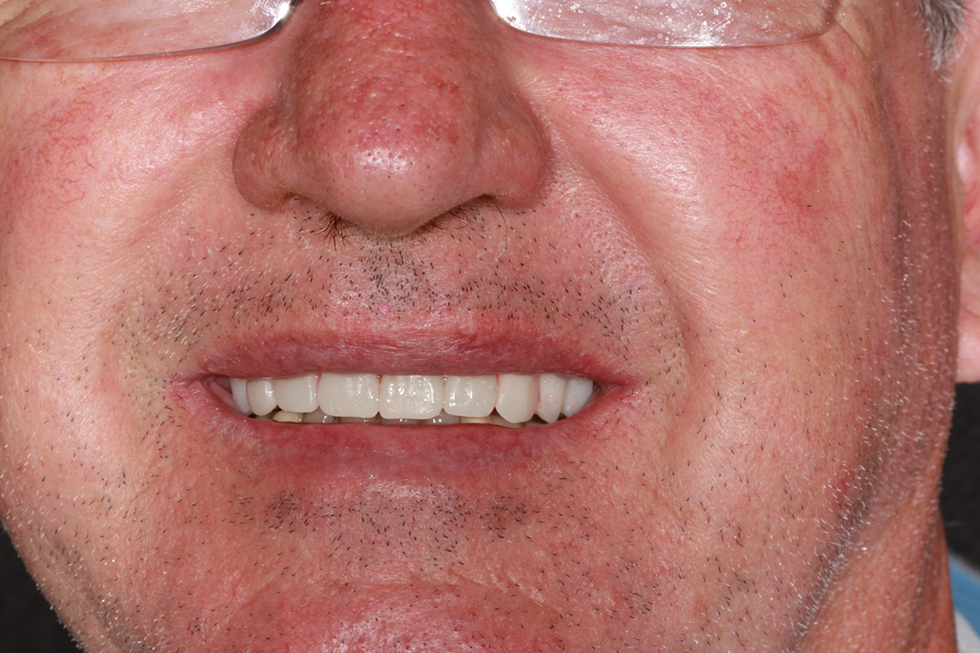 Depois do tratamento: Prótese Protocolo Sobre Implantes