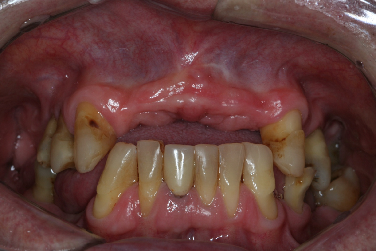 Antes do tratamento: Protocolo Imediato Sobre Implante