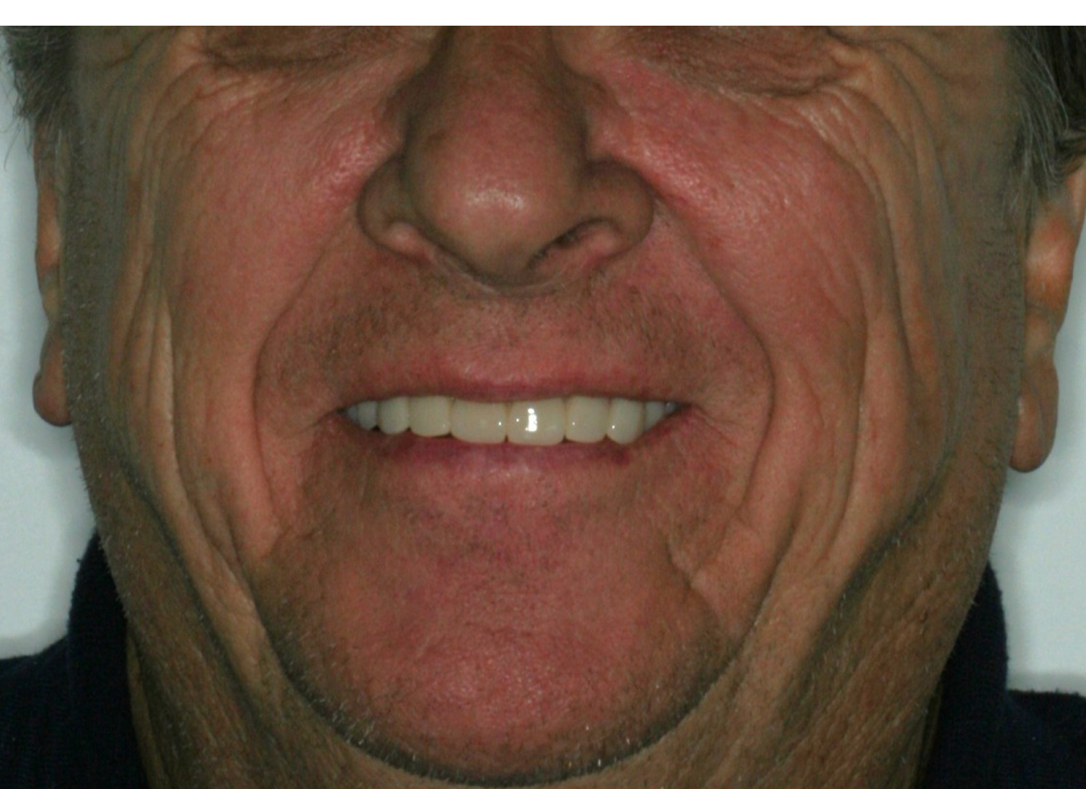 Depois do tratamento: Protocolo Imediato Sobre Implante