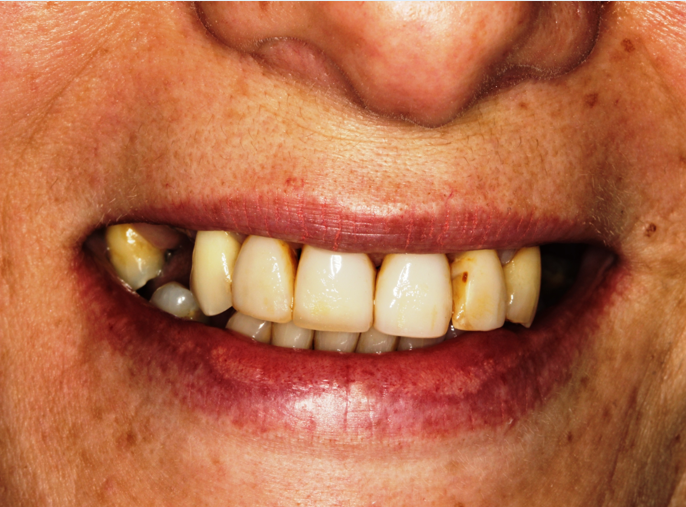 Antes do tratamento: Reabilitação Cerâmica 1