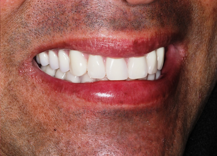 Depois do tratamento: Reabilitação Cerâmica 2