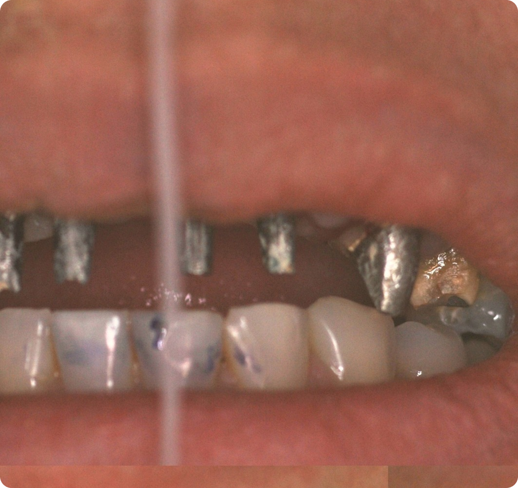 Antes do tratamento: Reabilitação Protética Sobre Implante