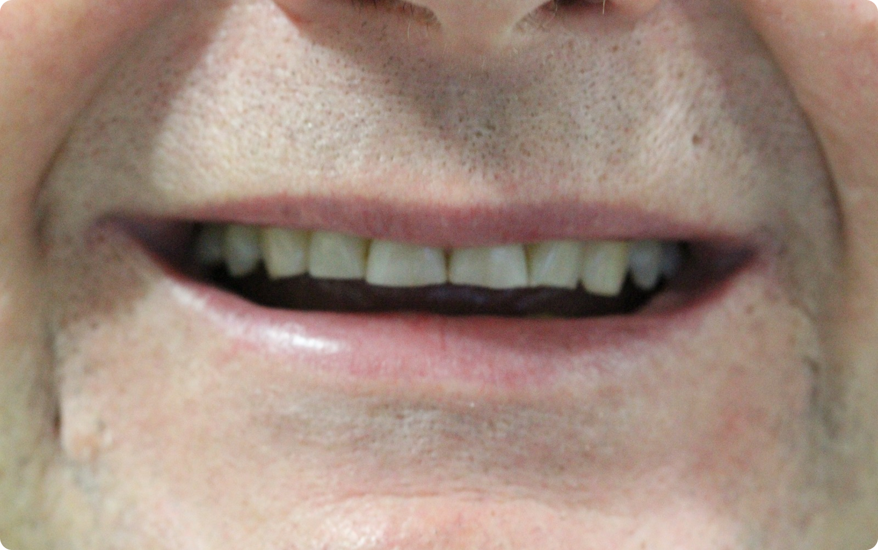 Antes do tratamento: Reabilitação Protética em Porcelana